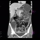 Crohn's disease, stenosis, prestenotic dilatation, CT enteroclysis, first examination: CT - Computed tomography